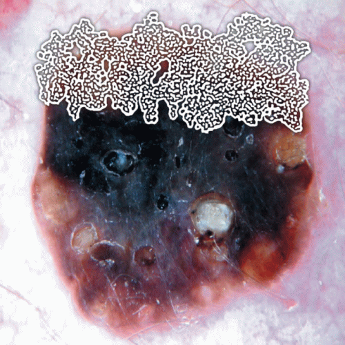 Seborrheic Keratosis : Cyst Stew